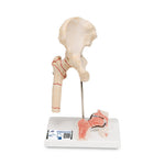 American 3b Scientific Lp Models: Osteoarthritis Femoral Hip Fracture Model 1000175 - 1.0 Each