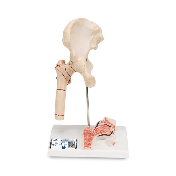 American 3b Scientific Lp Models: Osteoarthritis Femoral Hip Fracture Model 1000175 - 1.0 Each