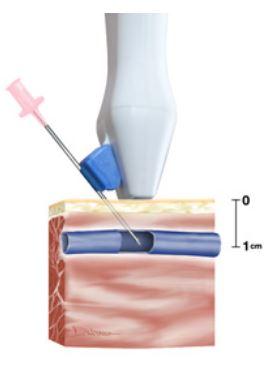 C.R. Bard Site Rite VISION Needle Guide with 96" Probe Cover, 20G - 9002096 - 10 Each
