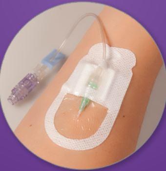 Securis IV Start Kit and Stabilization Devices - SK00002 - 50 Each - MDL-BARSK00002
