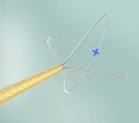 Cr Bard SkyLite Tipless Nitinol Stone Baskets - BRD041900