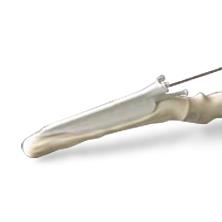 Civco Medical Disposable Endocavity Quick-Release Needle Guides H40462LD - 24.0 Each - MDL-CVCH40462LD