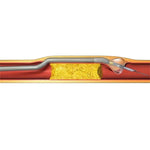 Boston Scientific Biliary Knives RX XL Triple-Lumen Needle Knife, 5 Fr, 5 mm, MSPV / Government Only - M00545840 - 1 Each