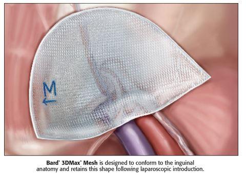 Cr Bard 3DMax Mesh 0115320 - 1.0 Each