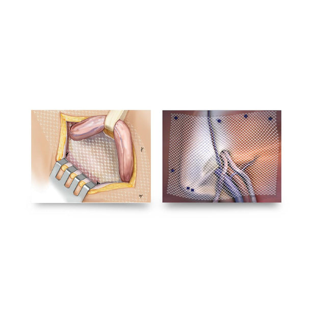 C.R. Bard Surgical Soft Mesh, 12" x 12" - 0117016 - 1 Each