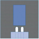 Bilateral Split Surgical Drape - DYNJP4007 - 20 Each - MDL-DYNJP4007