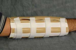 Em Adams Inc E. M. Adams Elbow Splints EP26-0421 - 6.0 Each