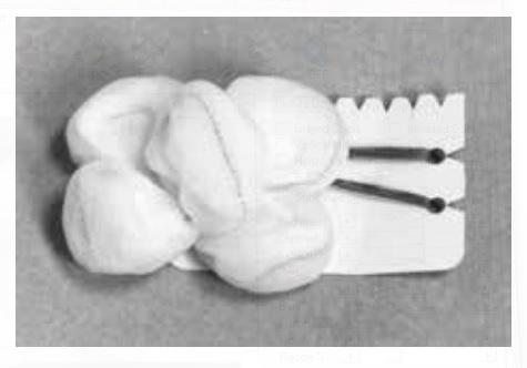 TELEFLEX MEDICAL Sterile Tonsil Sponges 200334 500 Each - MDL-HUD200334