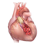 Cr Bard TRUE Flow Valvuloplasty Perfusion Catheter TF0203511 1.0 Each-MDL-IPRTF0203511