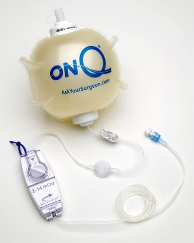 ON-Q Pump Kits with ON-Q SilverSoaker Catheter - PM020-A - 1 Each - MDL-K-CPM020AH