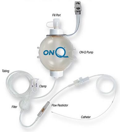 ON-Q Pump Kits with ON-Q SilverSoaker Catheter - PM025-A - 5 Each - MDL-K-CPM025A