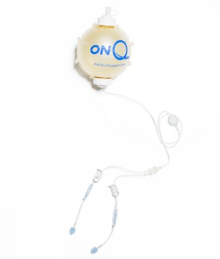 ON-Q Pump Kits with ON-Q SilverSoaker Catheter - PM045-A - 5 Each - MDL-K-CPM045A