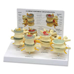 Nasco Healthcare 4-Stage Vertebrae Model SB35468UG - 1.0 Each