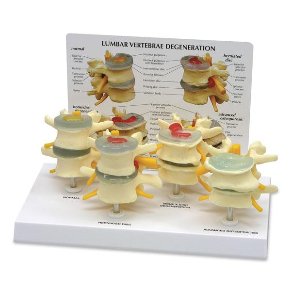 Nasco Healthcare 4-Stage Vertebrae Model SB35468UG - 1.0 Each