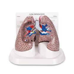 Nasco Healthcare Lung Set with Pathologies SB44894U - 1.0 Each - MDL-NSCSB44894U