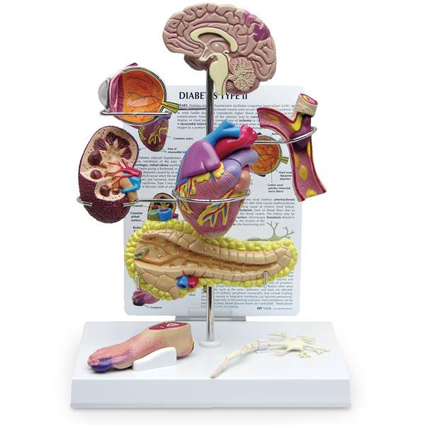 Nasco Healthcare Type 2 Diabetes Educational Model Set SB46335U - 1.0 Each