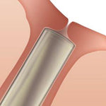 Oasis Medical Inc SOFT PLUG Collagen Punctual Plugs 6502 - 60.0 Each