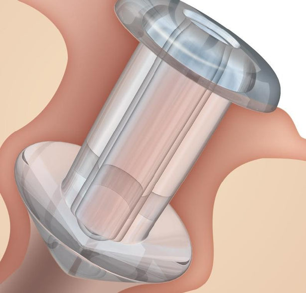 SOFT PLUG Silicone Punctal Plugs - 6614 - 2 Each - MDL-OAS6614