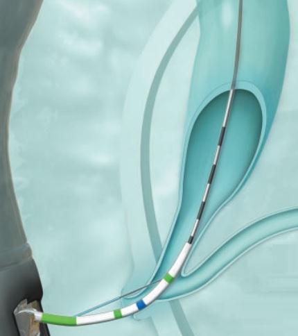 Olympus America Olympus CleverCut Sphincterotomes - OLPV411M0320
