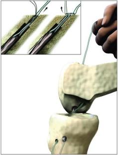 Smith Nephew Device Endobutton CL Ultra Fixation Button with 15 mm Continuous Loop Suture - SDY72200146