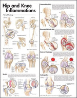 Wolters Kluwer Hip and Knee Inflammations Anatomical Chart, Laminated - 9780781773478 - 1 Each