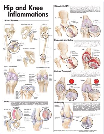 Wolters Kluwer Hip and Knee Inflammations Anatomical Chart, Laminated - 9780781773478 - 1 Each