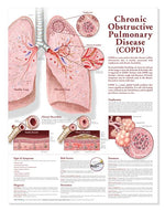 Wolters Kluwer COPD Anatomical Chart 9780781782371 - 1.0 Each