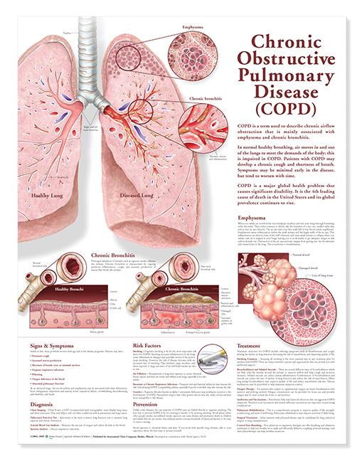 Wolters Kluwer COPD Anatomical Chart 9780781782371 - 1.0 Each