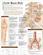 Wolters Kluwer Understanding Lower Back Pain Anatomical Chart, Paper - 9780781782425 - 1 Each