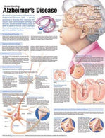Wolters Kluwer Understanding Alzheimer's Disease Anatomical Chart, Laminated - 9780781786348 - 1 Each