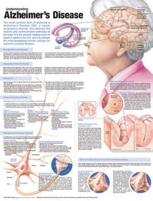 Wolters Kluwer Understanding Alzheimer's Disease Anatomical Chart, Laminated - 9780781786348 - 1 Each