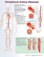 Wolters Kluwer Peripheral Artery Disease Chart 9781496370013 - 1.0 Each