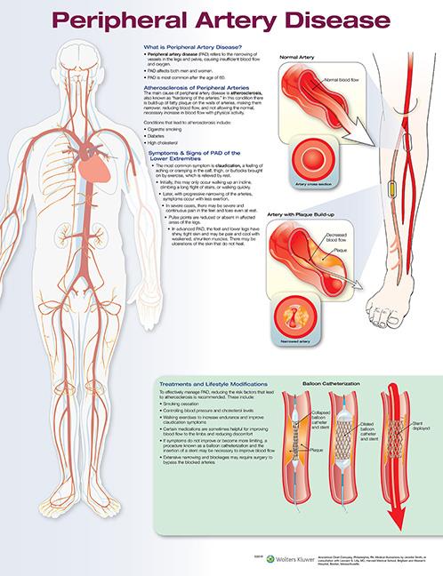 Wolters Kluwer Peripheral Artery Disease Chart 9781496370013 - 1.0 Each