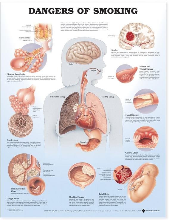 Wolters Kluwer Dangers of Smoking Chart 9781587792311 - 1.0 Each