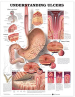 Wolters Kluwer Understanding Ulcers Anatomical Chart 9781587793714 - 1.0 Each