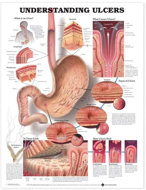 Wolters Kluwer Understanding Ulcers Anatomical Chart 9781587793714 - 1.0 Each