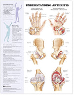 Wolters Kluwer Understanding Arthritis Anatomical Chart 9781587793868 - 1.0 Each