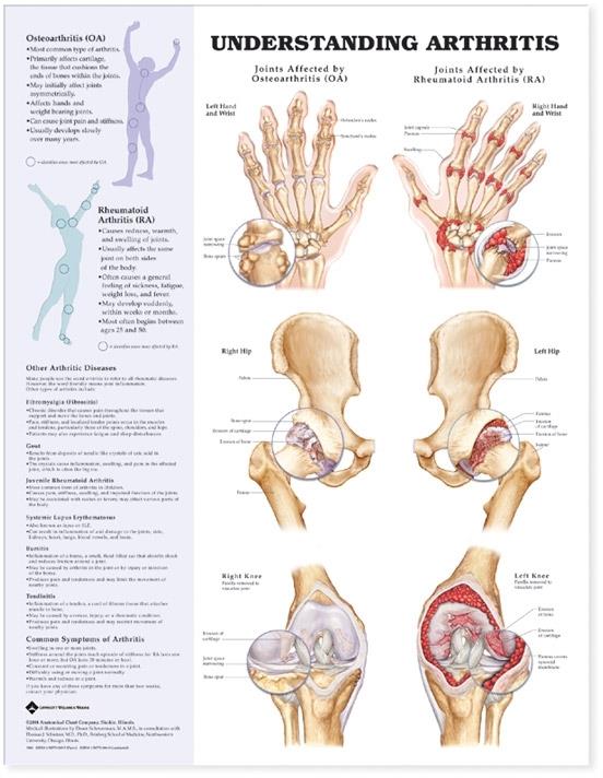 Wolters Kluwer Understanding Arthritis Anatomical Chart 9781587793868 - 1.0 Each