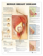 Wolters Kluwer Benign Breast Disease Anatomical Chart 9781587796746 - 1.0 Each