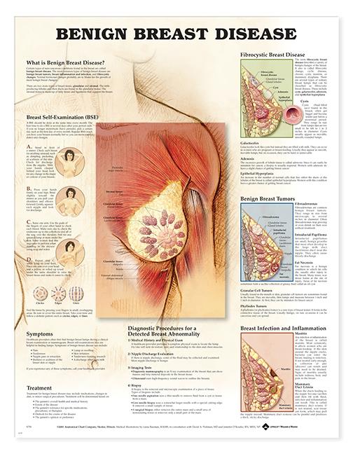 Wolters Kluwer Benign Breast Disease Anatomical Chart 9781587796746 - 1.0 Each