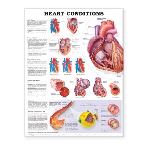 Wolters Kluwer Heart Conditions Anatomical Charts 9781587798825 - 1.0 Each