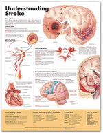 Wolters Kluwer Understanding Stroke Anatomical Chart, English, Laminated - 9781587799884 - 1 Each