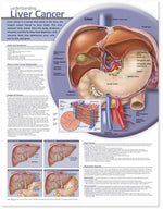 Understanding Liver Cancer Anatomical Chart - 9781605470924 - 1 Each - MDL-WKH1605470924